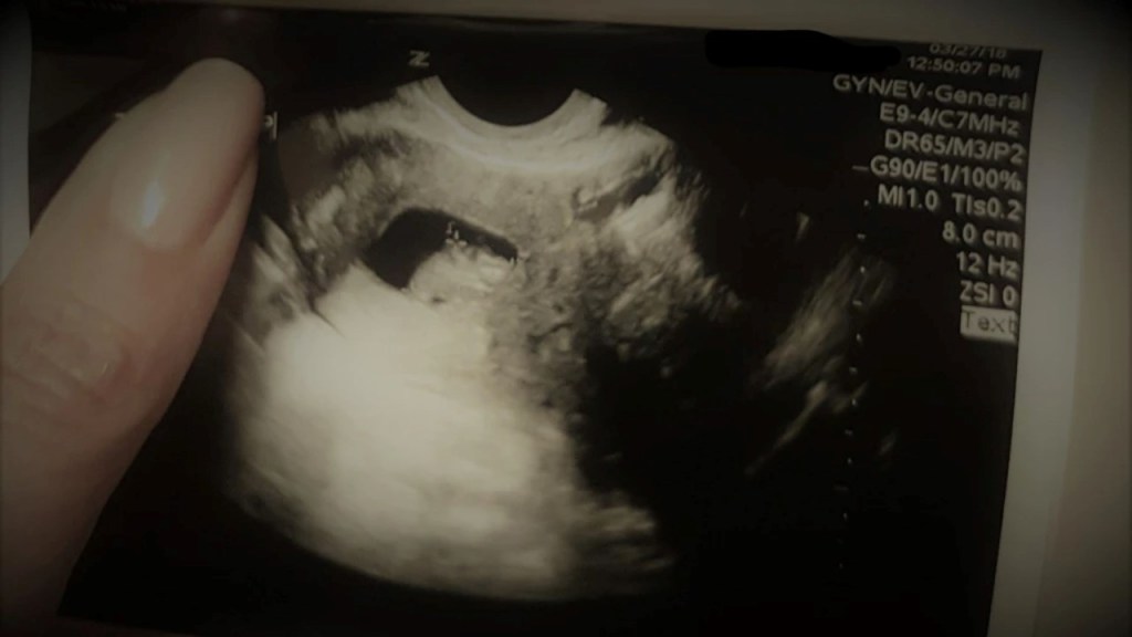 A woman's hand holding a photo of an ultrasound. The image shows the uterus is nearly completely blocked with endometriosis growth and fibroids 